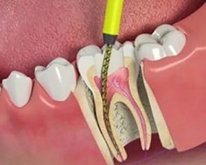 root canal treatment service