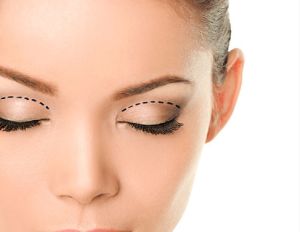 Blepharoplasty Surgery