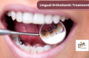 Lingual Braces Services