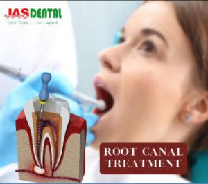 Root Canal Treatment