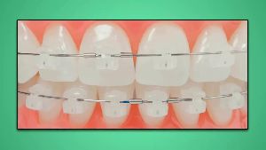 Orthodontic Material