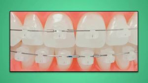 Orthodontic Material