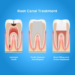 Root Canal Treatment