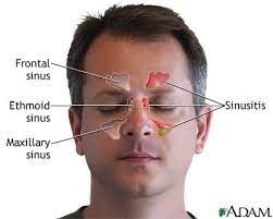 Sinusitis Treatment