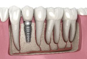 Dental Implants