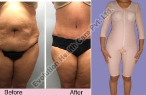 Lycra Cotton Liposuction Compression Garments at Rs 2000/piece in New Delhi