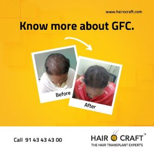 hair fall treatment