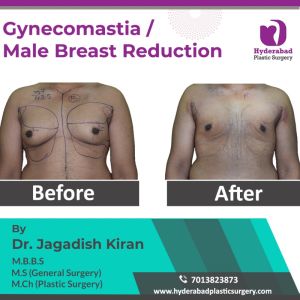 gynecomastia surgery