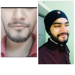 Moustache Hair Transplant
