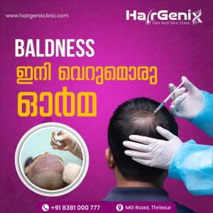 baldness treatment