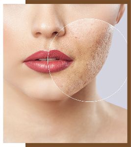 best treat acne scars treatment