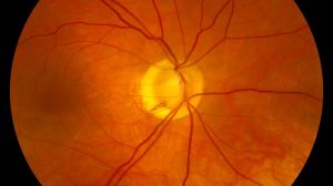 Retinopathy Stem Cell Treatment Services
