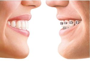 Dental Braces Treatment Services