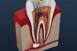 Painless Root Canal Treatment