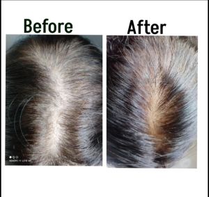 hair fall treatment