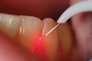 laser dentistry kollam