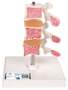 vertebral osteoporosis model