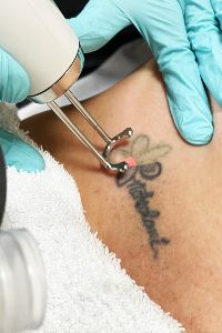 Tattoo Removal