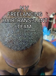 Hair Transplant surgery