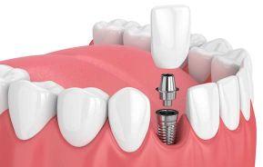 Dental Implants