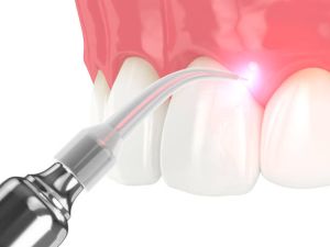 laser dentistry services