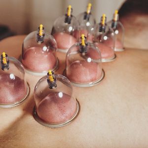 Cupping Therapy