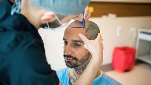 Hair Transplant in Delhi