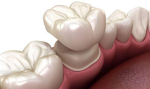 Dental Crowns