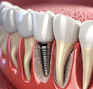 Dental Implants