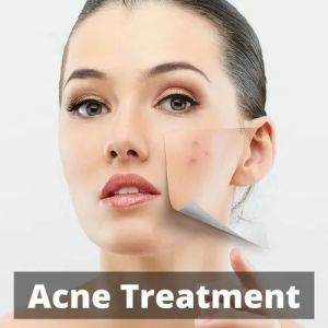 Acne Treatment Services