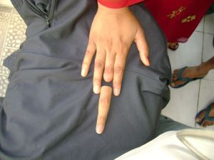 SILICONE FINGER PROSTHESIS