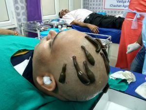 Leech Therapy