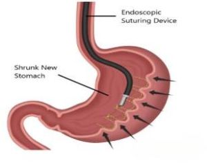 Endoscopic Sleeve Gastroplasty