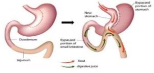 mini gastric bypass surgery