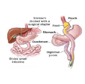 Roux-en-y-Gastric Bypass