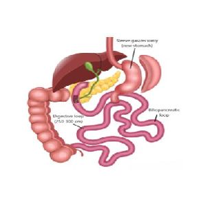 sadi-s bariatric surgery