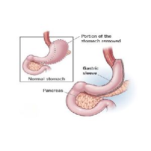 Sleeve Gastrectomy