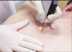 Laser Surgery Treatment Services