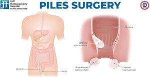 Piles Treatment