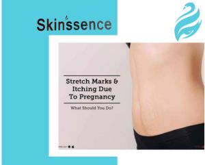 stretch marks removal service