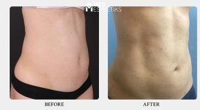 Liposuction surgery in delhi