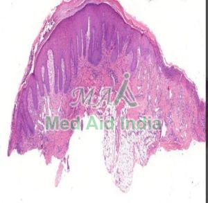 Traumatic Ulcer Tongue Prepared Microscope Slide