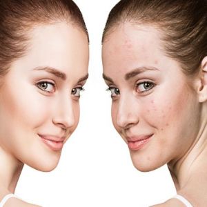 Laser Acne Scar Treatment