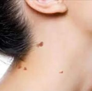 Skin Tag Removal Treatment