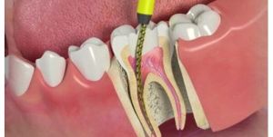 Root Canal Treatment