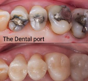 Dental cosmetic Restoration