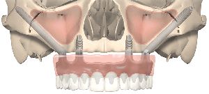 teeth zygomatic implants