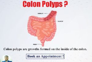 Colon Polyps Best Gastroenterologist