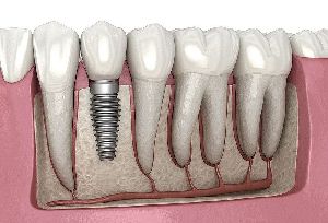 Dental Implants