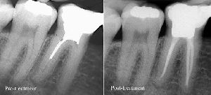 Root Canal Treatment